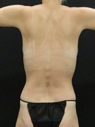 Tummy Tuck: Case 72 - After