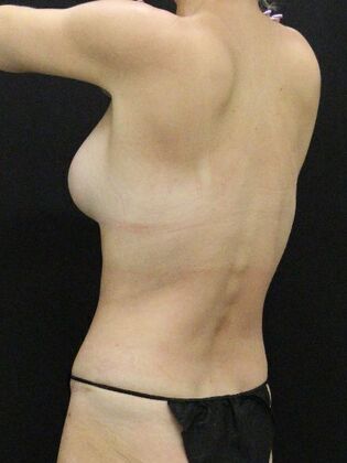 Tummy Tuck: Case 72 - After