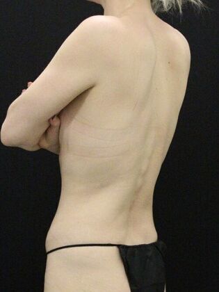 Tummy Tuck: Case 72 - Before