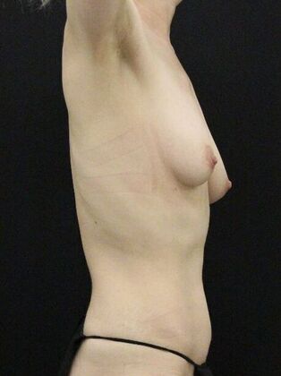 Tummy Tuck: Case 72 - Before