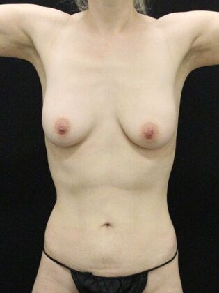 Tummy Tuck: Case 72 - Before