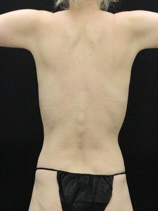 Tummy Tuck: Case 72 - Before