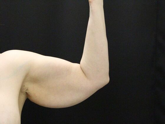 Arm Lift & Reduction: Case 12 - Before