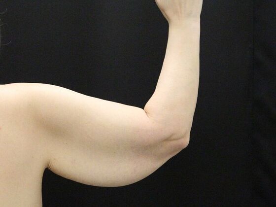 Arm Lift & Reduction: Case 12 - Before