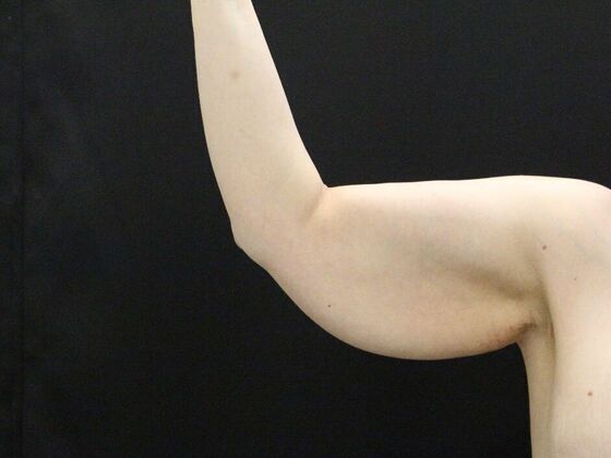 Arm Lift & Reduction: Case 12 - Before
