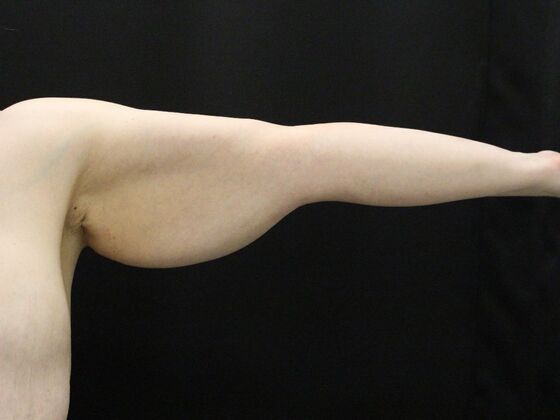 Arm Lift & Reduction: Case 12 - Before