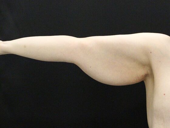 Arm Lift & Reduction Case 12 - Before