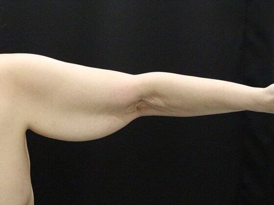 Arm Lift & Reduction: Case 12 - Before