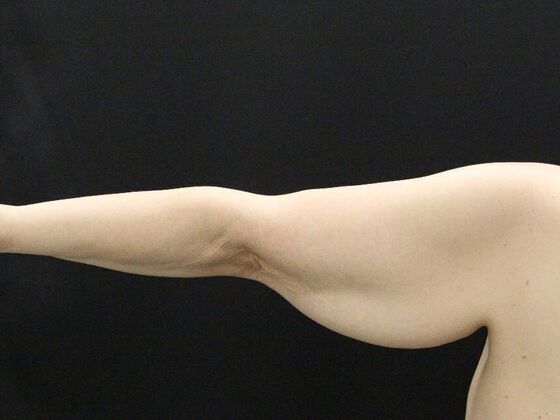 Arm Lift & Reduction: Case 12 - Before