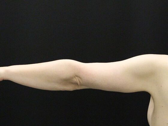 Arm Lift & Reduction: Case 12 - After