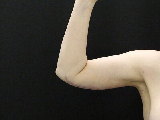 Arm Lift & Reduction: Case 12 - After