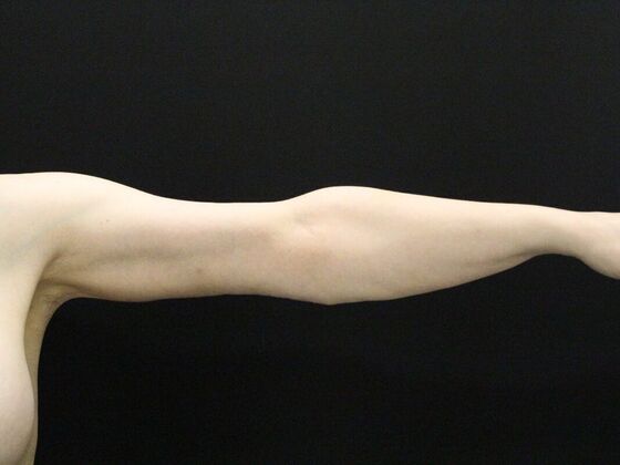 Arm Lift & Reduction: Case 12 - After