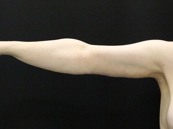 Arm Lift & Reduction Case 12 - After