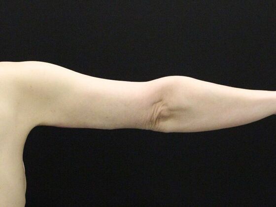 Arm Lift & Reduction: Case 12 - After