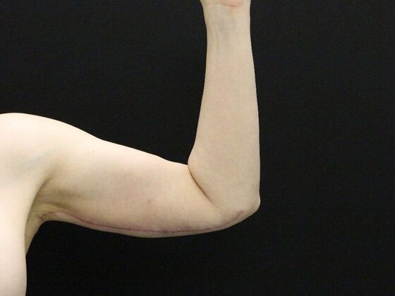 Arm Lift & Reduction: Case 12 - After