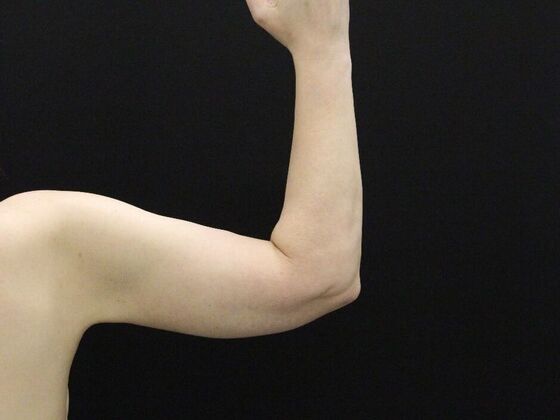 Arm Lift & Reduction: Case 12 - After