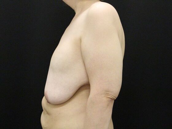 Breast Reduction & Lift: Case 34 - Before