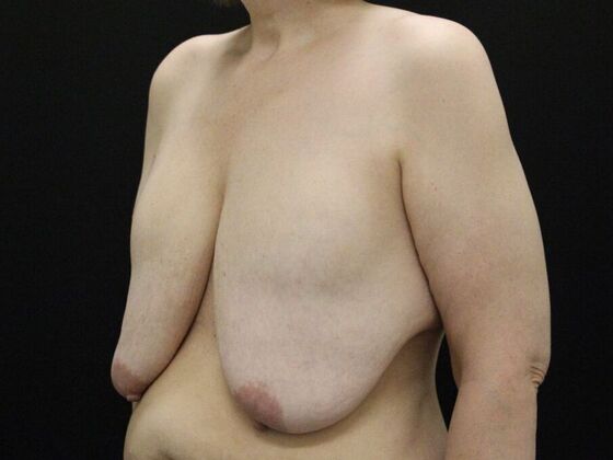 Breast Reduction & Lift: Case 34 - Before