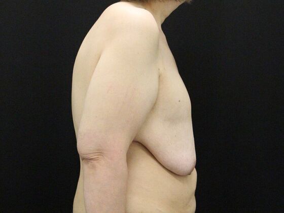 Breast Reduction & Lift: Case 34 - Before