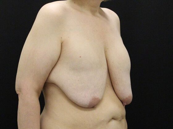 Breast Reduction & Lift: Case 34 - Before