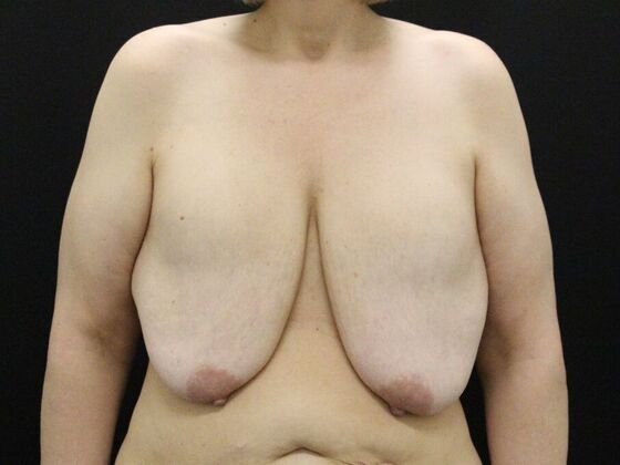 Breast Reduction & Lift Case 34 - Before