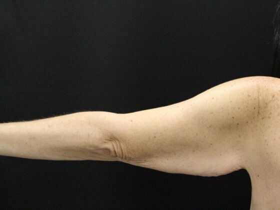 Arm Lift & Reduction: Case 13 - Before