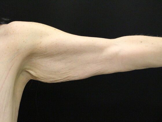 Arm Lift & Reduction: Case 13 - Before