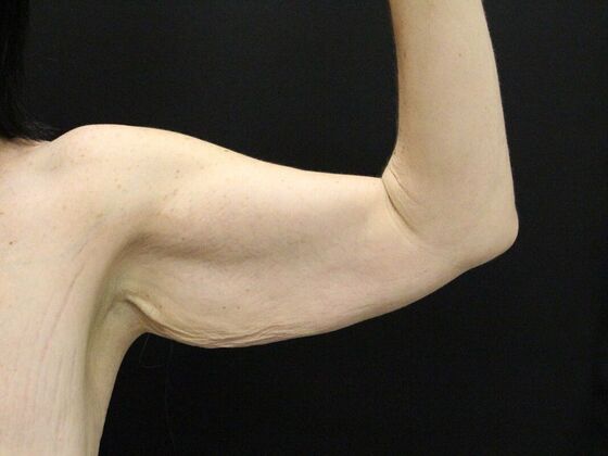 Arm Lift & Reduction: Case 13 - Before