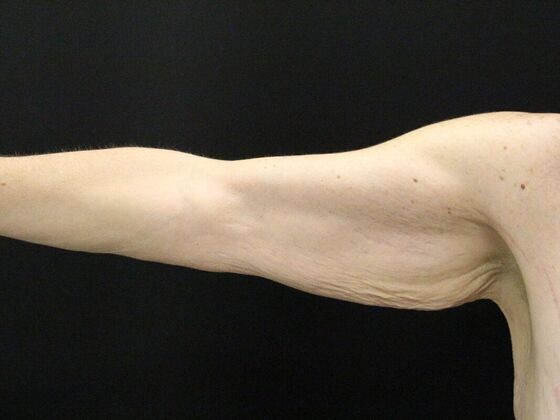 Arm Lift & Reduction: Case 13 - Before
