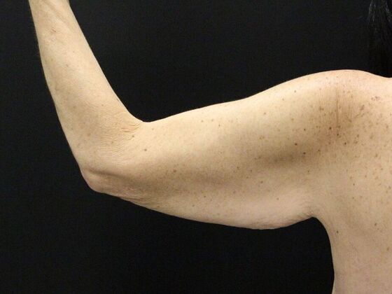 Arm Lift & Reduction: Case 13 - Before