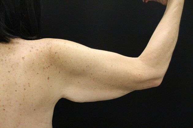 Arm Lift & Reduction: Case 13 - Before