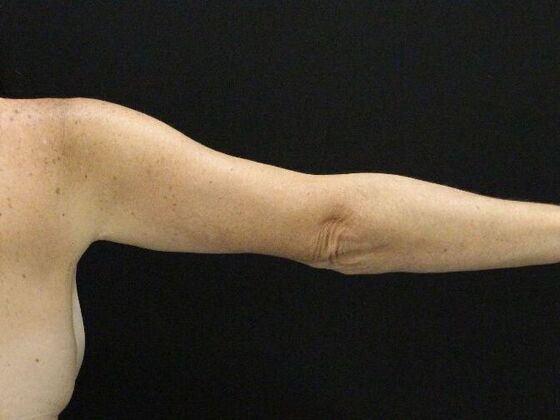 Arm Lift & Reduction: Case 13 - After