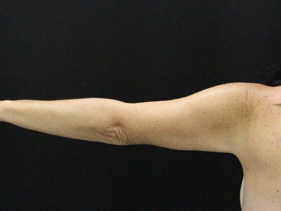 Arm Lift & Reduction: Case 13 - After