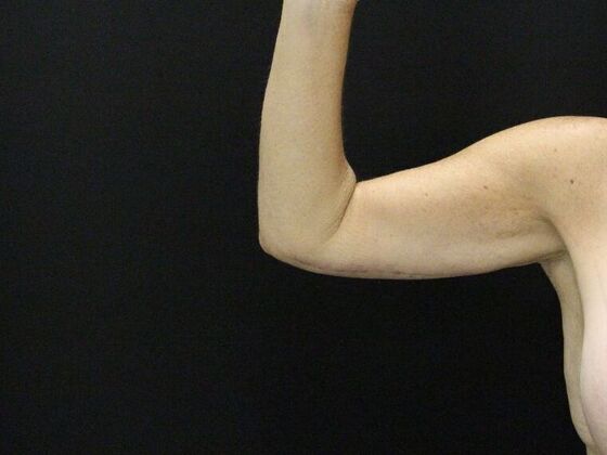 Arm Lift & Reduction Case 13 - After