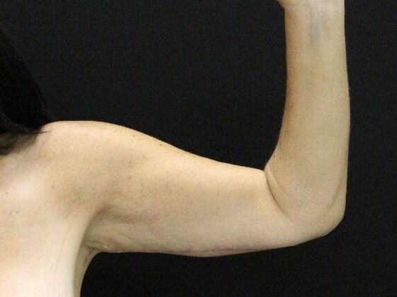 Arm Lift & Reduction: Case 13 - After