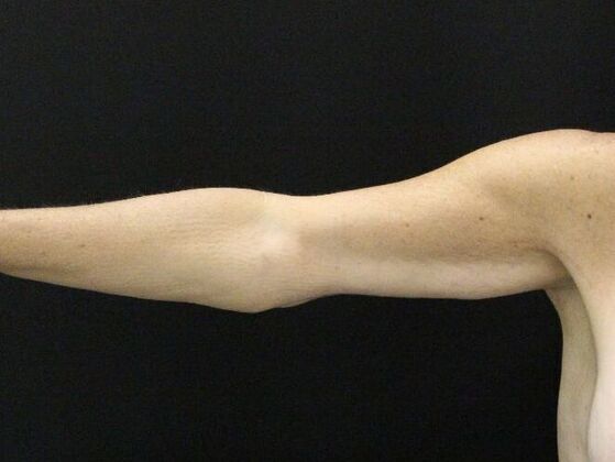 Arm Lift & Reduction: Case 13 - After