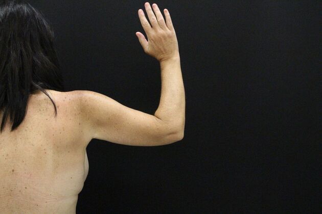 Arm Lift & Reduction: Case 13 - After