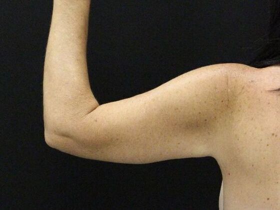 Arm Lift & Reduction: Case 13 - After