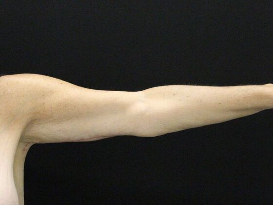 Arm Lift & Reduction: Case 13 - After