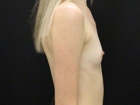 Breast Augmentation: Case 53 - Before