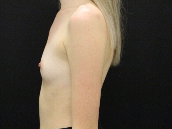 Breast Augmentation: Case 53 - Before