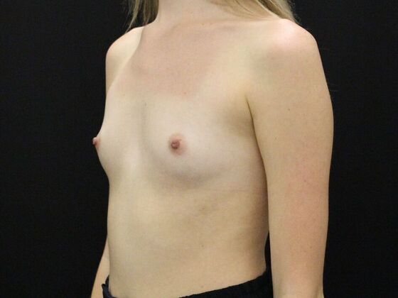 Breast Augmentation: Case 53 - Before
