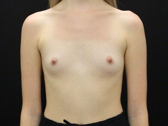 Breast Augmentation Case 53 - Before