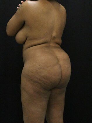 Tummy Tuck: Case 73 - Before