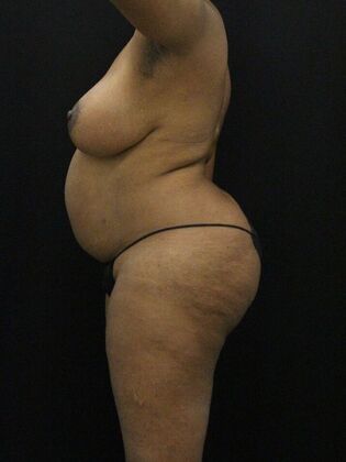 Tummy Tuck: Case 73 - Before