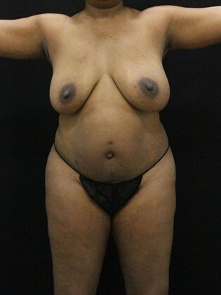 Tummy Tuck: Case 73 - Before