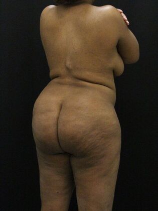 Tummy Tuck: Case 73 - Before