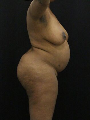 Tummy Tuck Case 73 - Before