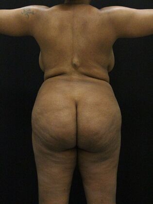 Tummy Tuck: Case 73 - Before