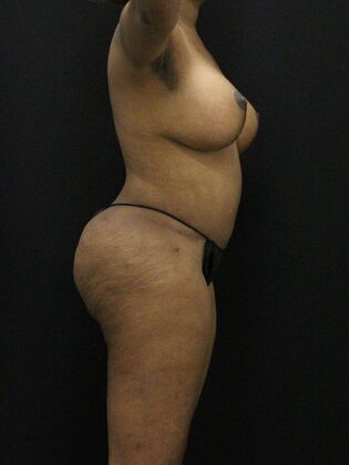 Tummy Tuck Case 73 - After